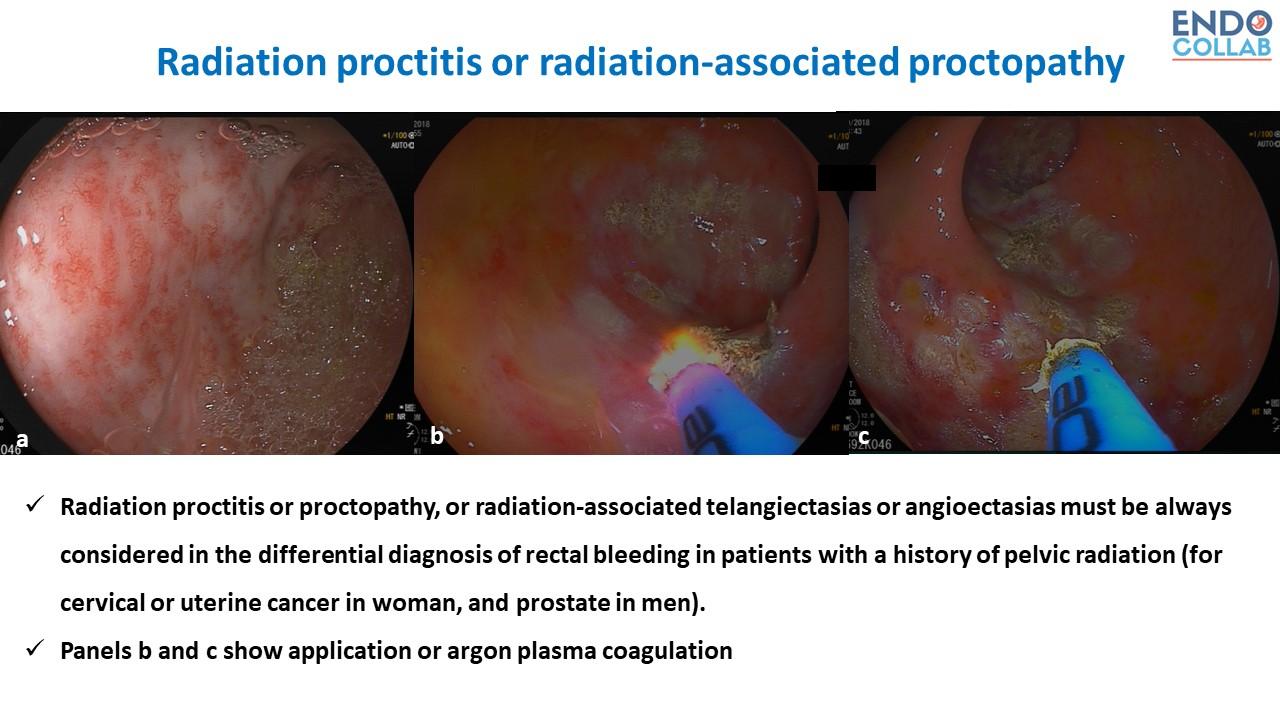 Six Top Tips To Use Argon Plasma Coagulation When Treating Angiodysplasias: An Endoscopic Atlas