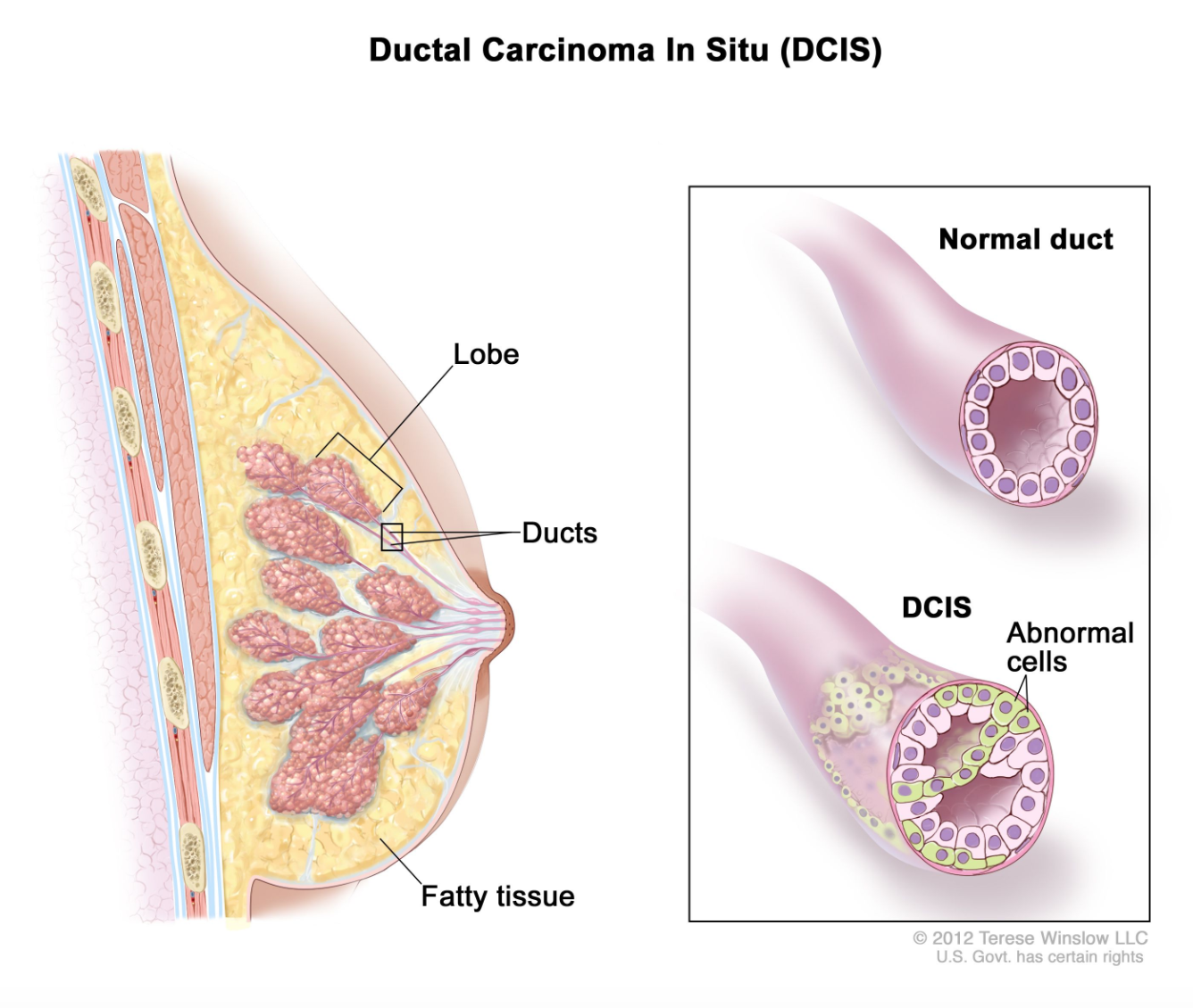Ductal Carcinoma in Situ (DCIS): Understanding Stage 0 Breast Cancer