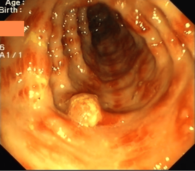 Cronkhite Canada Syndrome (Ccs)