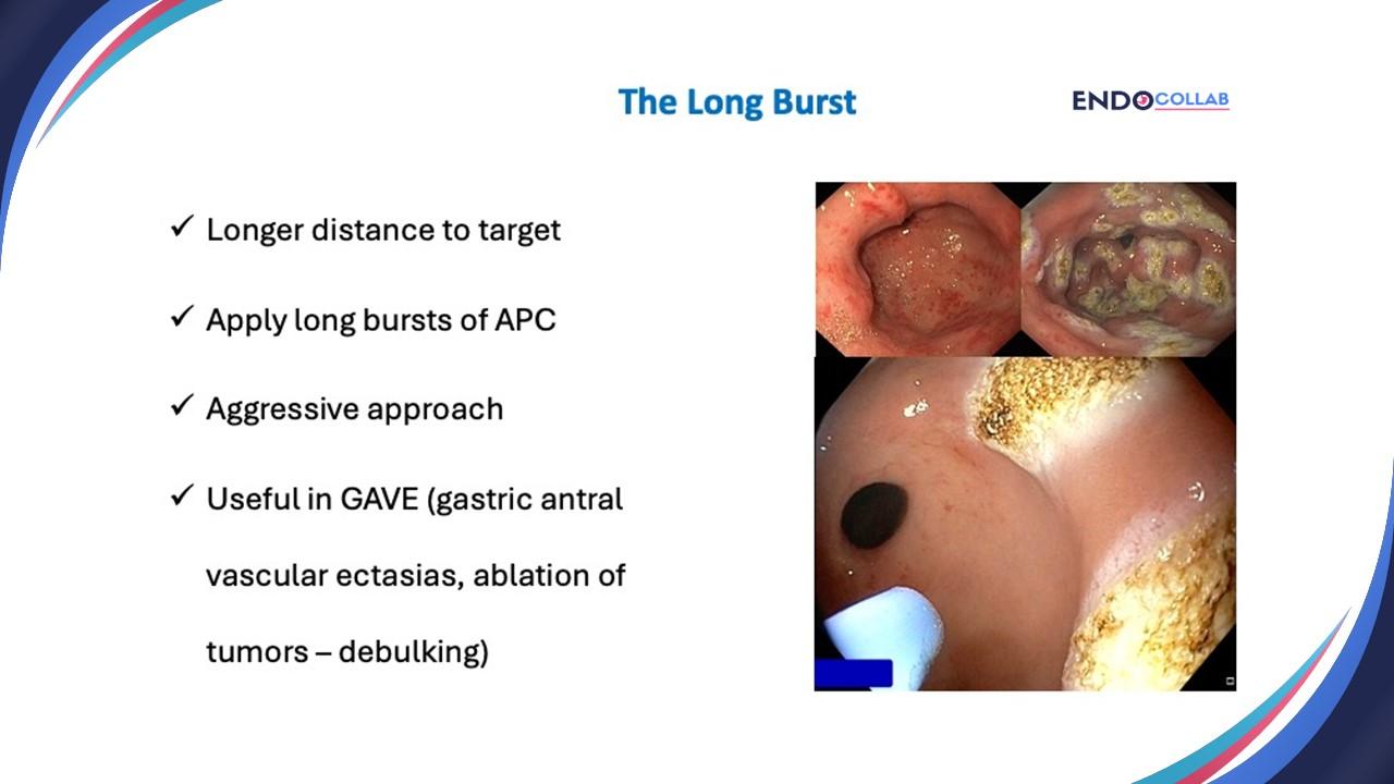 Six Top Tips To Use Argon Plasma Coagulation When Treating Angiodysplasias: An Endoscopic Atlas