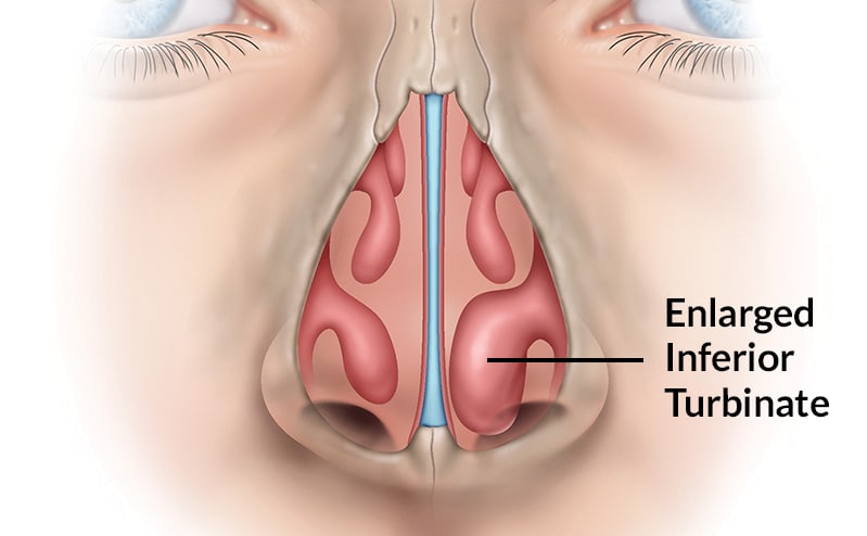 Surgeon s Guide Septoplasty And Turbinate Reduction surgeon-s-guide-septoplasty-and-turbinate-reduction