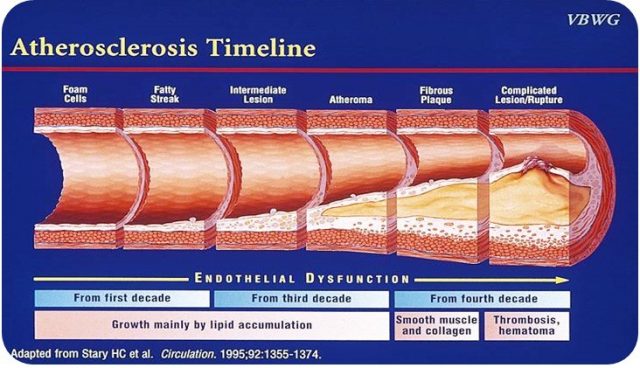 Risk for Atherosclerosis - Itamar Medical Risk for Atherosclerosis - Itamar Medical