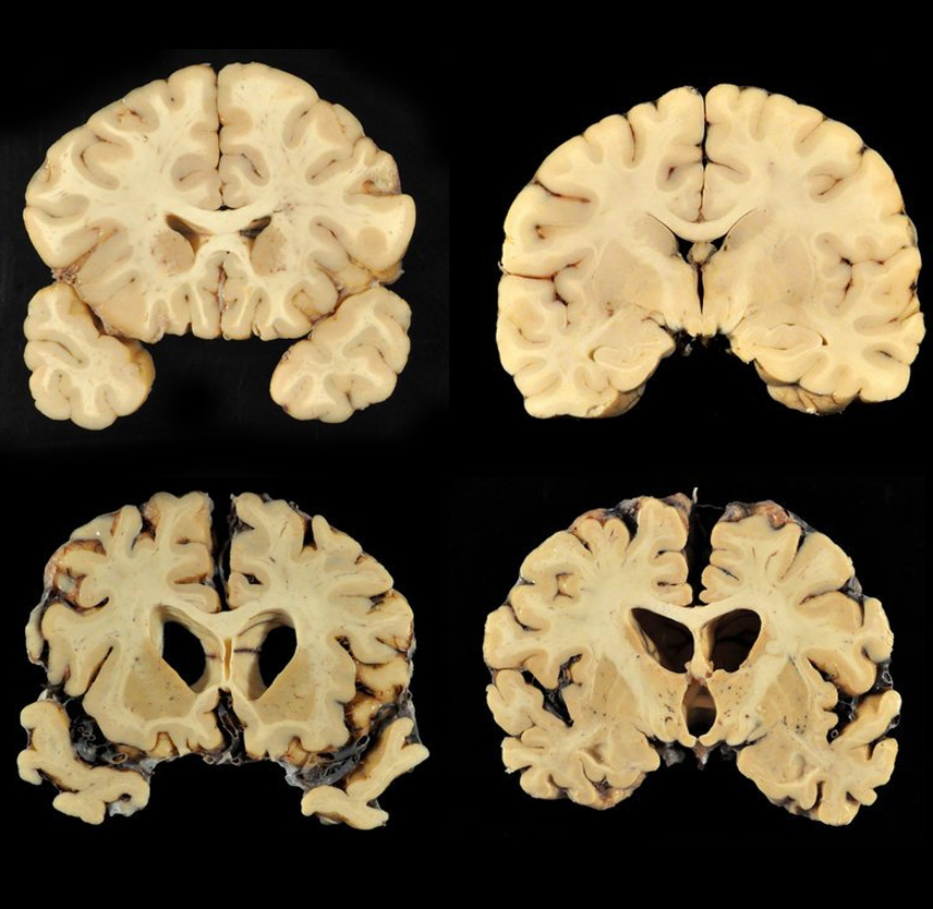 CTE in Athletes: A Study of Brain Injuries