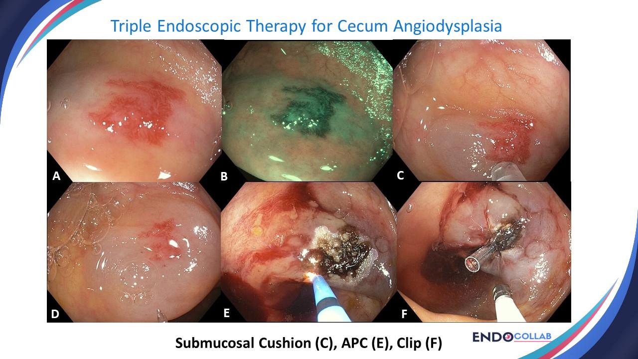 Six Top Tips To Use Argon Plasma Coagulation When Treating Angiodysplasias: An Endoscopic Atlas