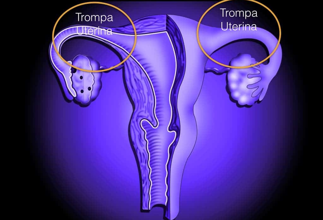 Saúde das trompas: entenda a hidrossalpinge, obstrução que pode causar infertilidade