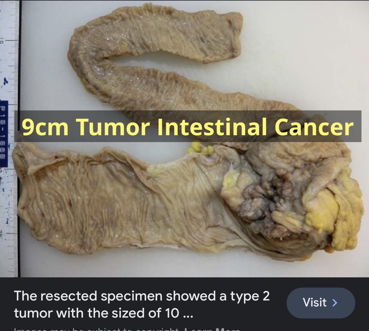 Real Front Line Doctor Now On Front Line Of Cancer