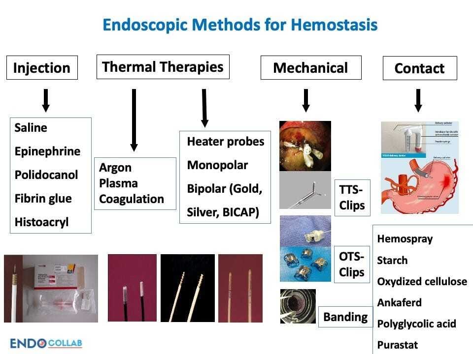 Treating Upper Gastrointestinal Bleeding: An Update on Endoscopic ...
