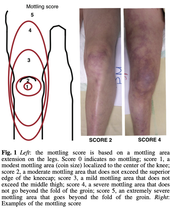 [Sepse e Choque] Mottling Score: quando a pele revela mais do que o ...