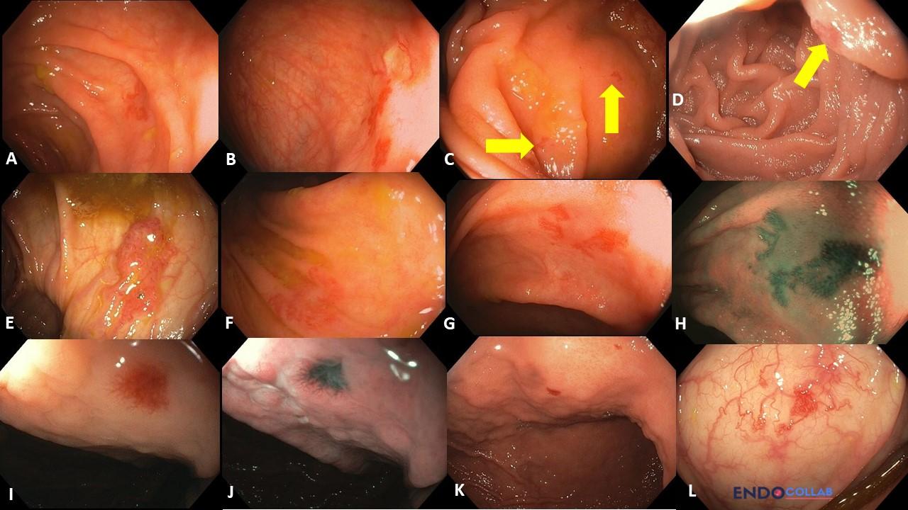 Six Top Tips To Use Argon Plasma Coagulation When Treating Angiodysplasias: An Endoscopic Atlas