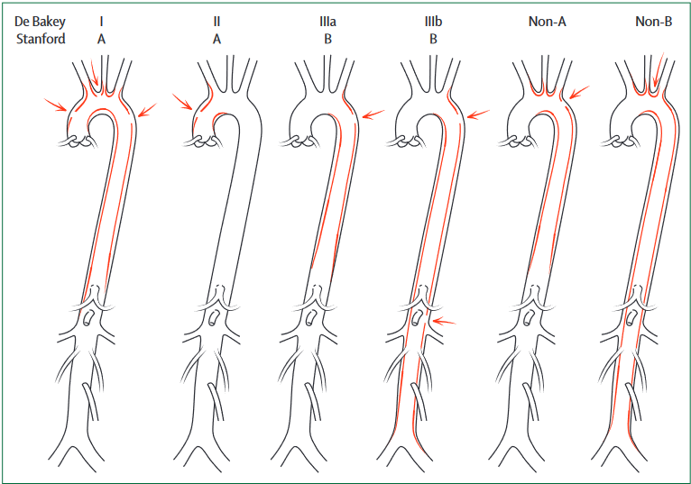Dissection Classification Pad Síndromes Aórticas Agudas