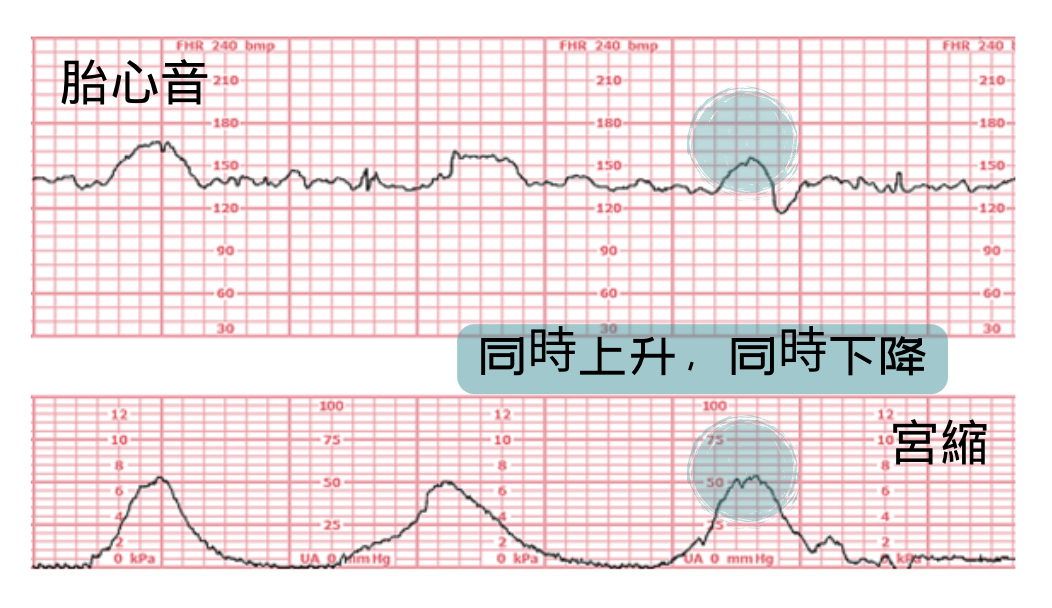護理筆記產科 – 胎心音 - 薇布WeiBuh💉護理站