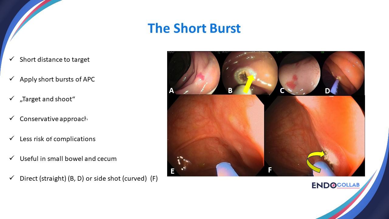 Six Top Tips To Use Argon Plasma Coagulation When Treating Angiodysplasias: An Endoscopic Atlas