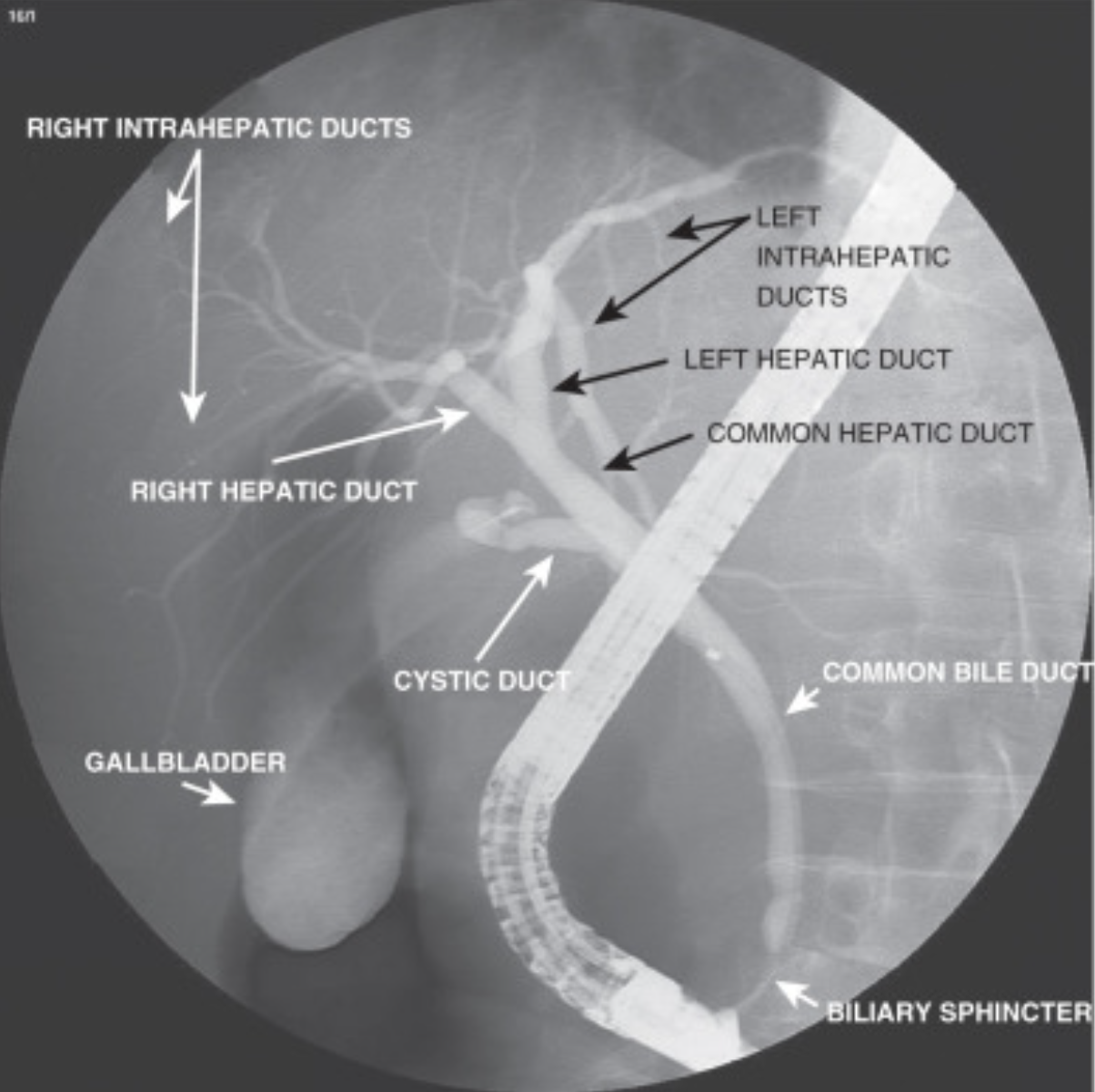 ERCP Explained: Why It's Done and What to Expect