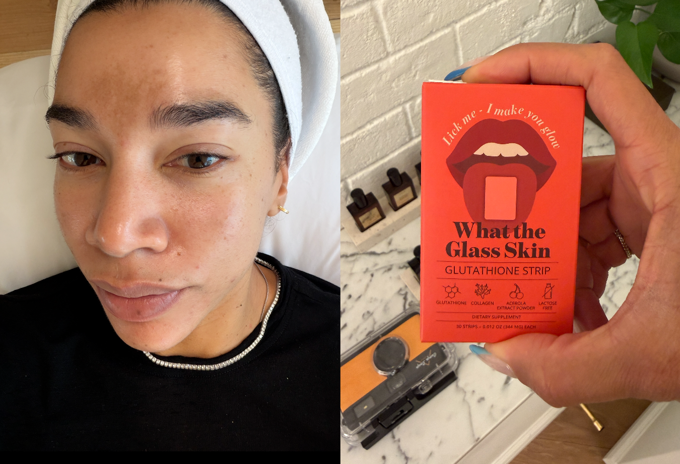how to make glutathione powder Melasma (and microneedling), 15 months later