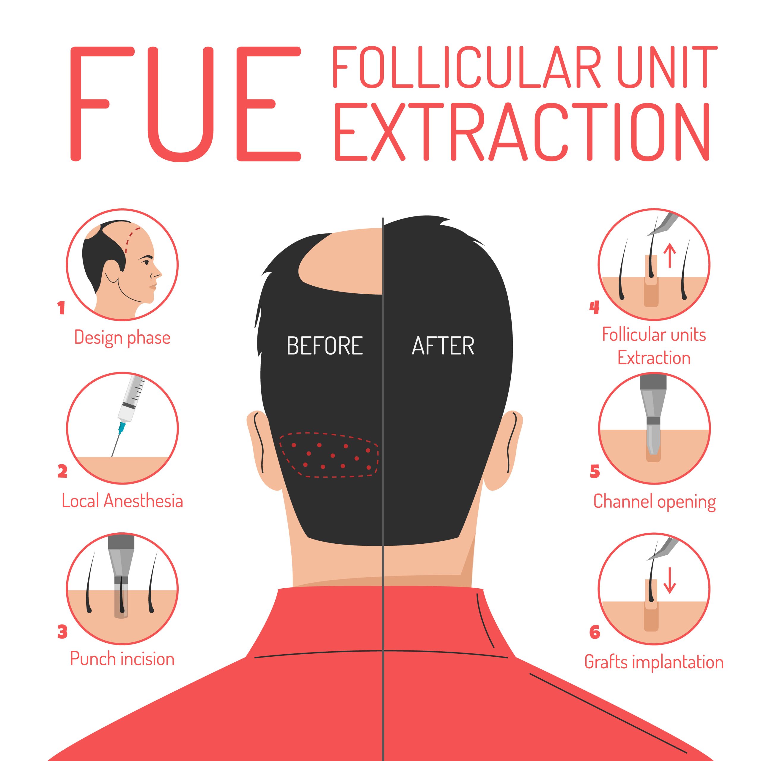 https://www.hairman.com/wp-content/uploads/2024/10/everything-about-fue-hair-transplant-scaled.jpeg