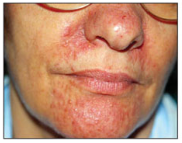 Acneiform Eruptions vs Acne: How to Tell the Difference and What to Do