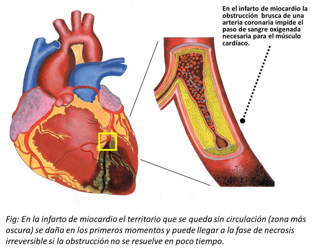 Qué es el infarto agudo de miocardio? Qué es el infarto agudo de miocardio?