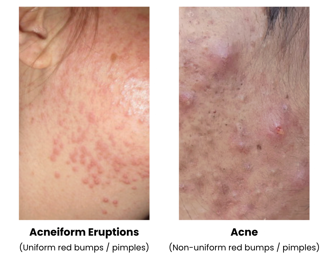 Acneiform Eruptions vs Acne: How to Tell the Difference and What to Do