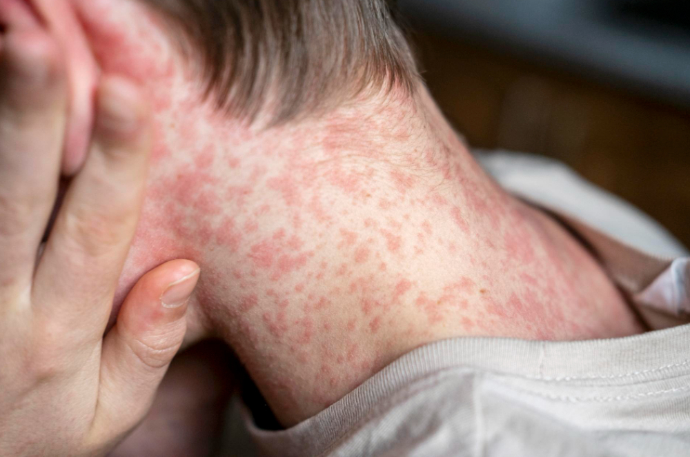 Efeito antivax: Mais de 130 estudantes são colocados em quarentena na Carolina do Sul por surto de sarampo nos EUA