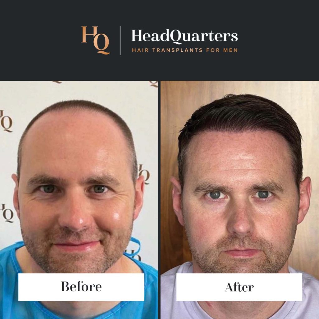 https://hqhairtransplants.com/wp-content/uploads/2024/07/hair-transplant-before-and-after-template-2-12-1024x1024.jpg