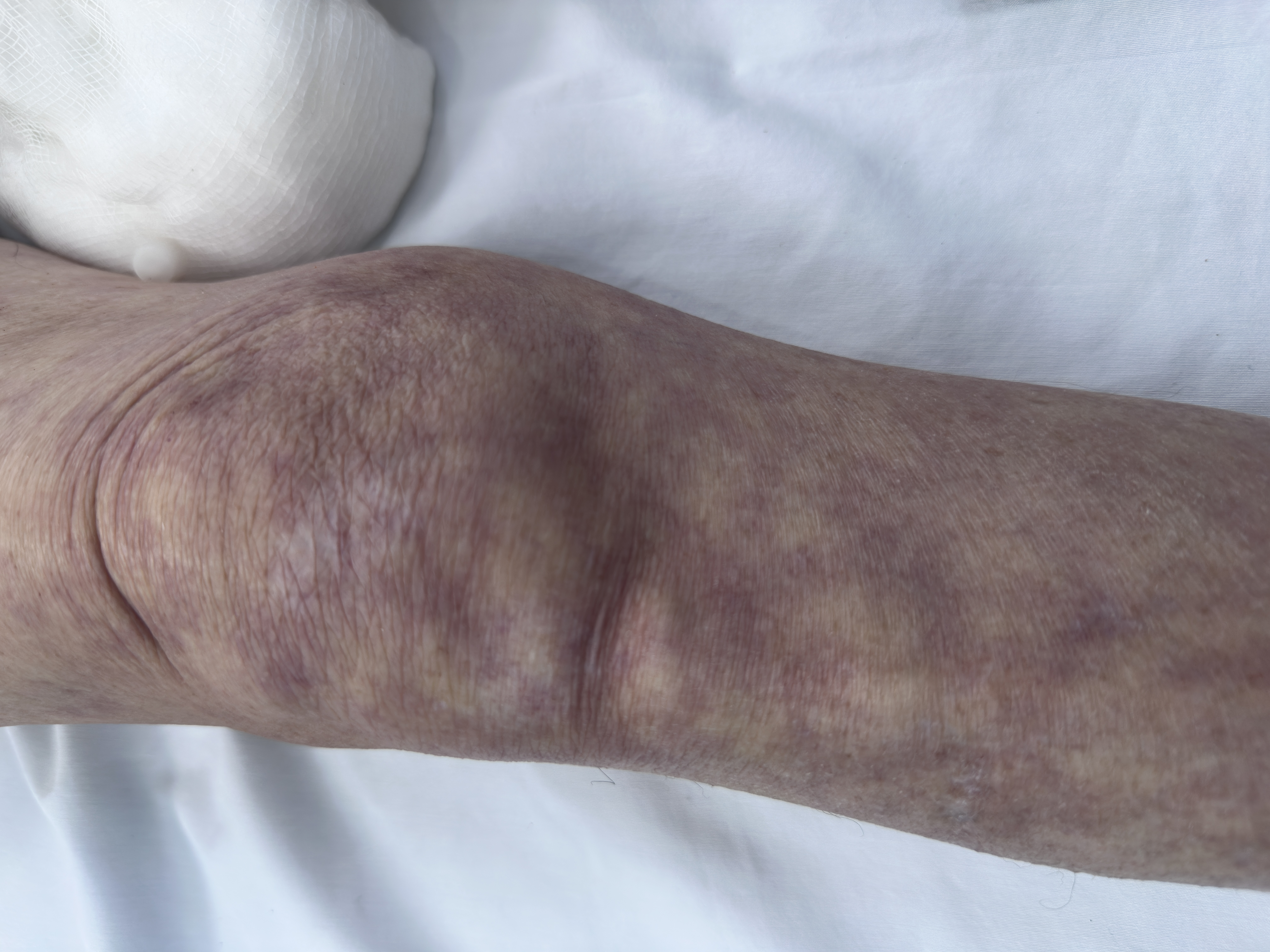 [Sepse e Choque] Mottling Score: quando a pele revela mais do que o ...