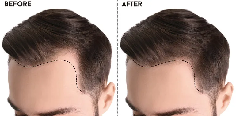 https://kopelmanhair.com/wp-content/uploads/2025/03/hairline-design-Importance-in-hair-transplant.webp