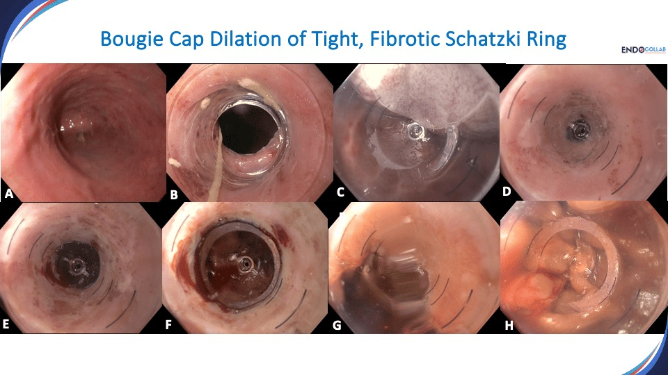 Technical Review: Esophageal Dilation With The Bougiecap