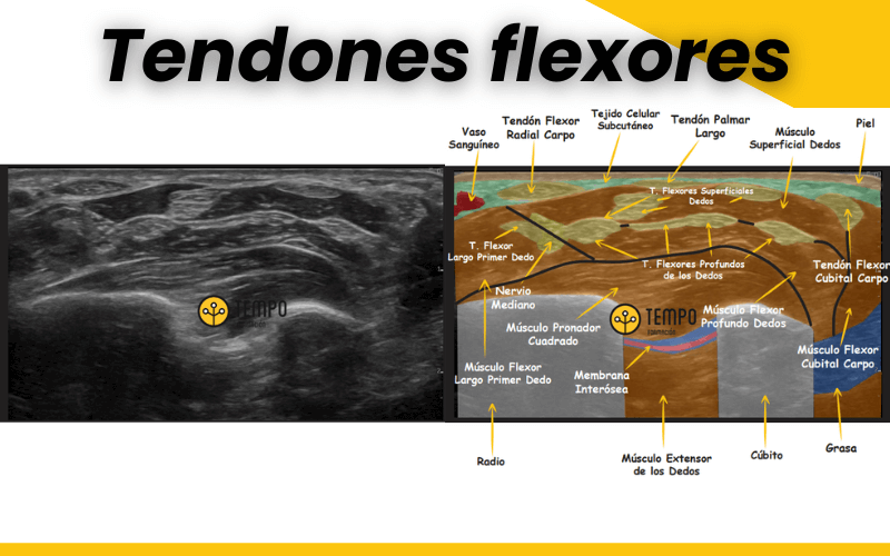 Anatomía ecográfica de la muñeca en 4 cortes 🔍