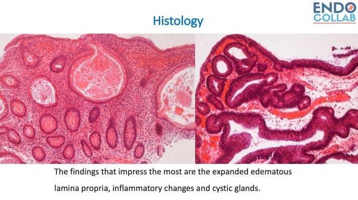 Cronkhite Canada Syndrome (Ccs)