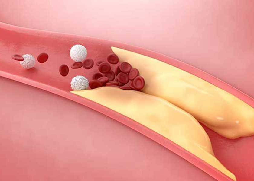 Heart Scan Study Finds Low-Fiber Diets Raise Risk of Dangerous Artery Plaque