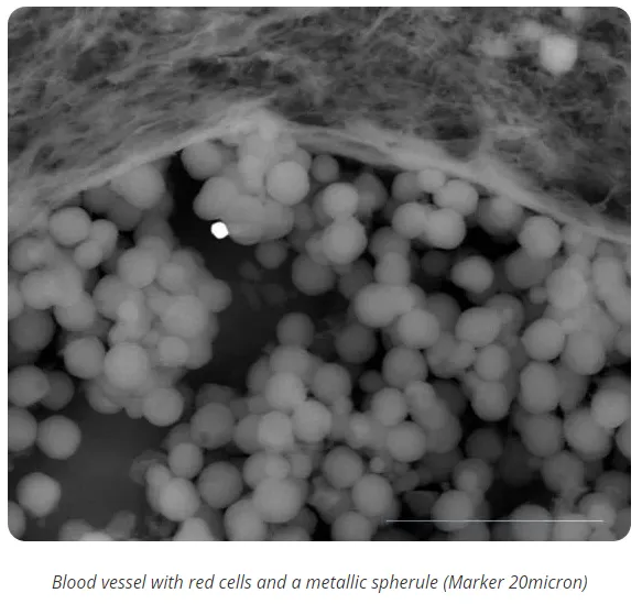 Electron Microscopy Of The Blood Of A 43 Year Old With 3 Pfizer ...