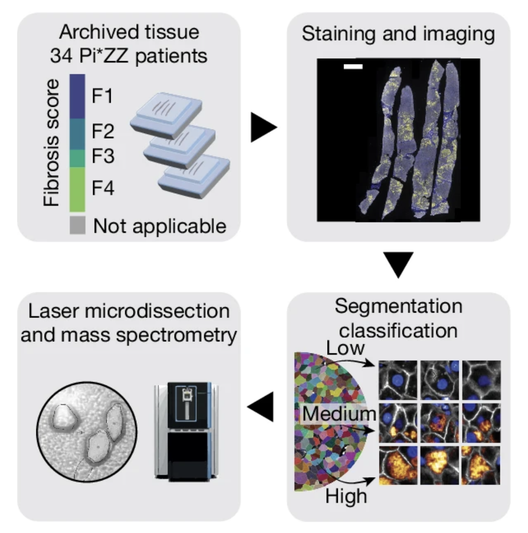Deep Visual Proteomics and Its Promise for Understanding Diseases