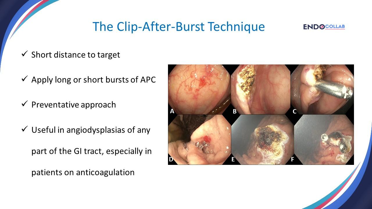 Six Top Tips To Use Argon Plasma Coagulation When Treating Angiodysplasias: An Endoscopic Atlas