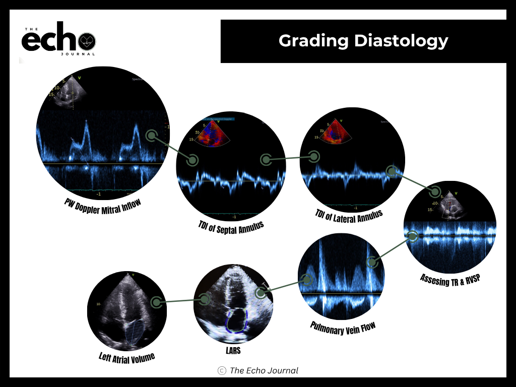 Diastolic Dysfunction Algorithm Ase For Af Grading Diastolic Function: The ASE Algorithm, Step by Step