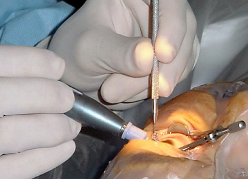 Jewish Invention Myths: Cataract Surgery