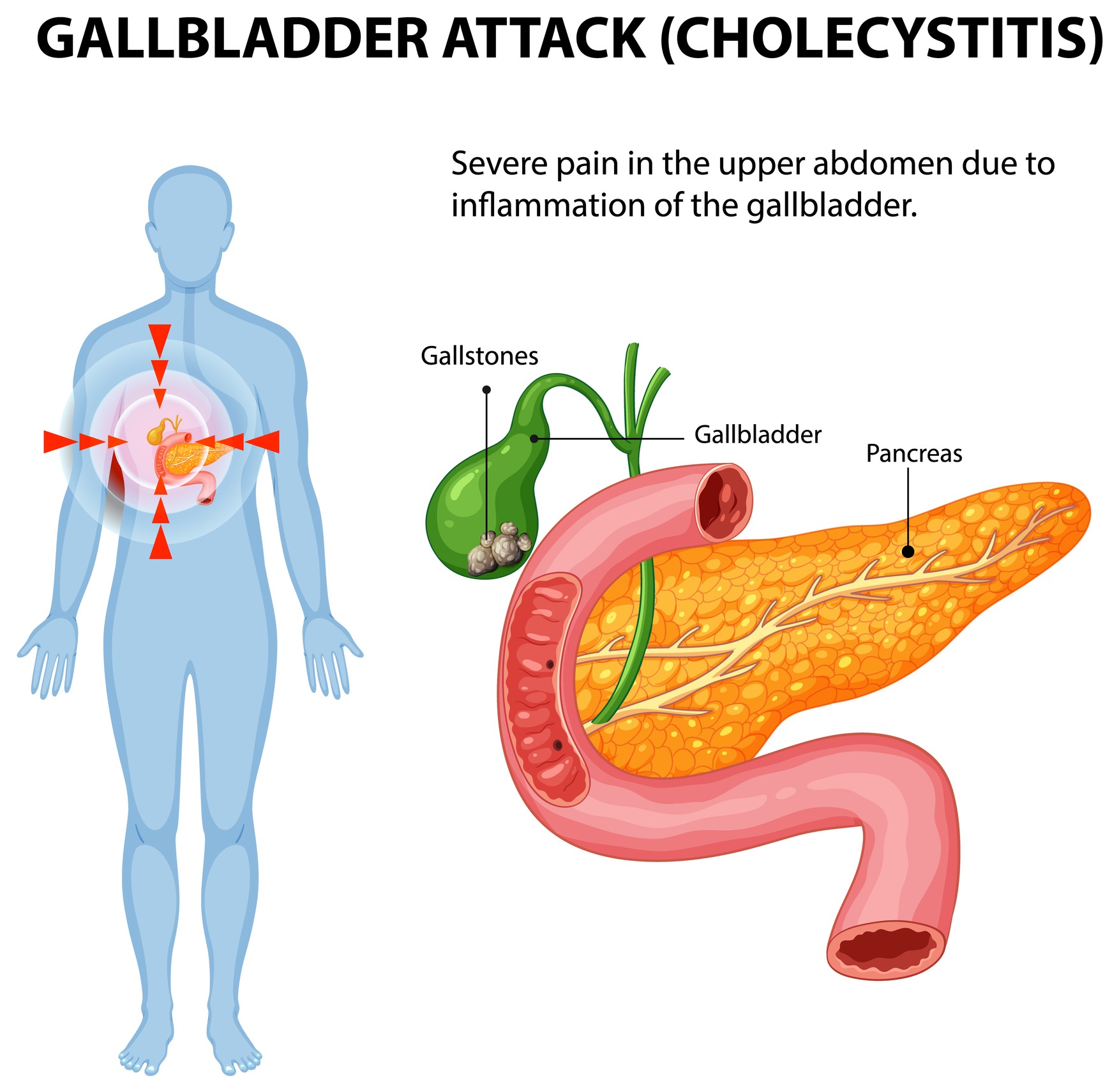 Menopause Hormone Therapy and Gallbladder Disease