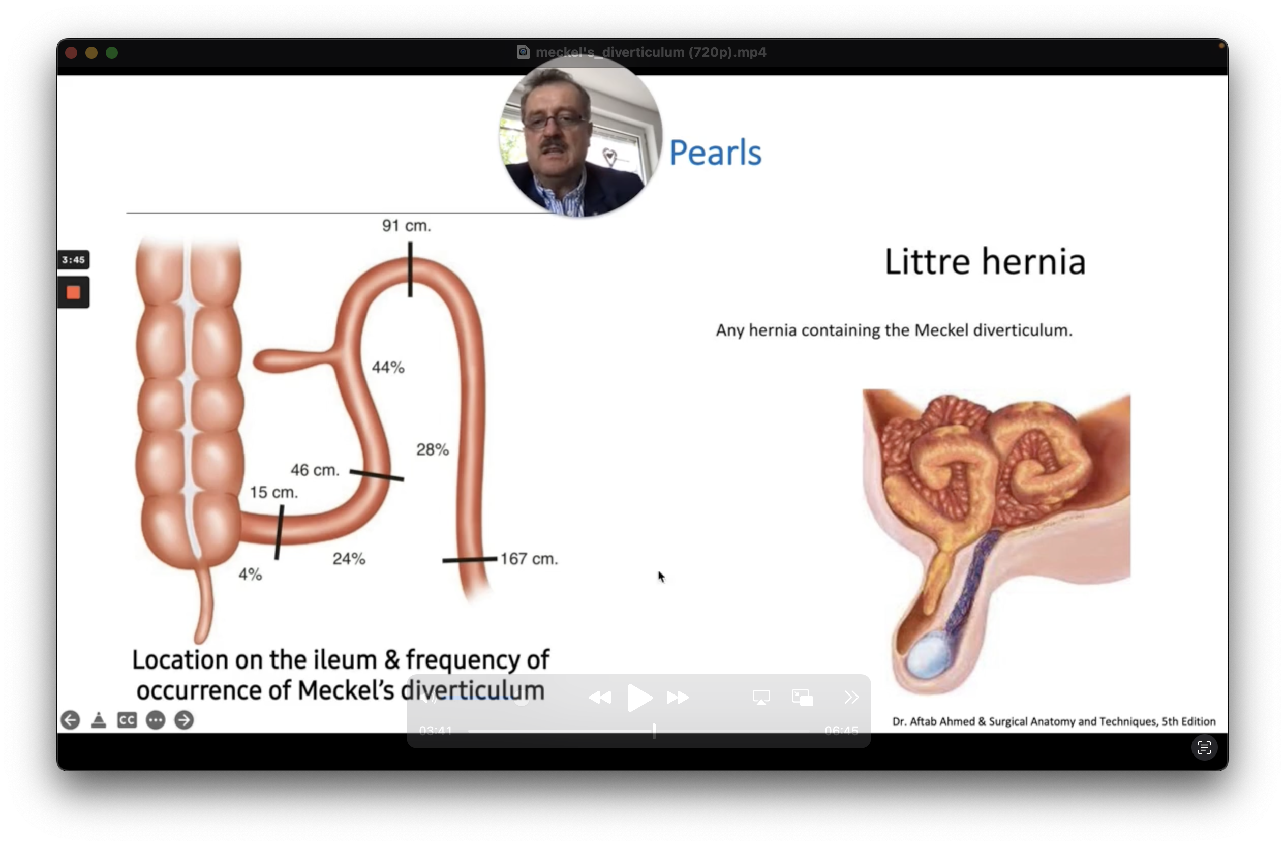 Meckel Process Meckel's Diverticulum: When the Rule of Twos Meets Real-World Endoscopy