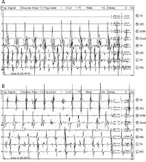 Classical Orthostatic Tremor. (A) A 14 ...