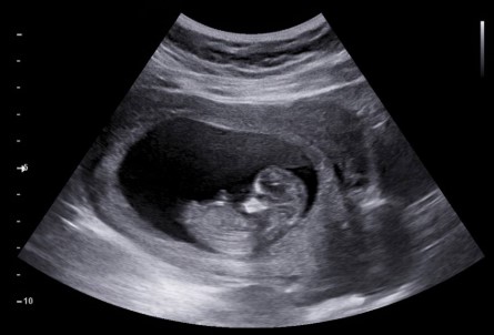 Jewish Invention Myths: The Sonogram/Ultrasound