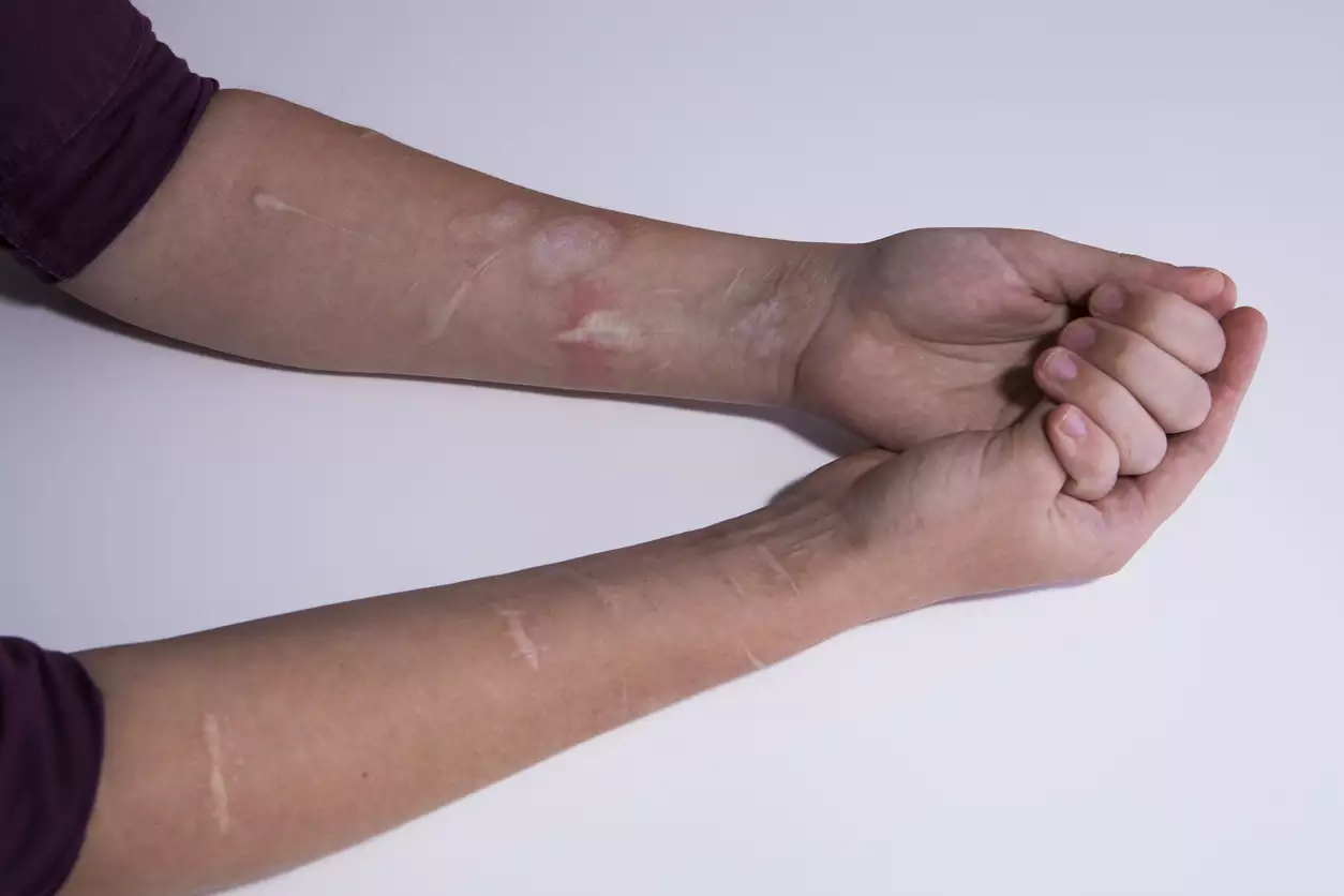 Escolas serão obrigadas a denunciar casos de automutilação e suicídio; índices disparam entre jovens