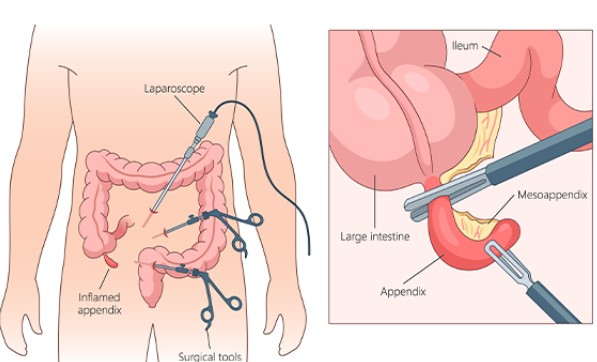 Jewish Invention Myths: The Appendectomy