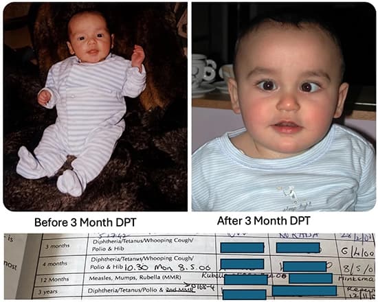 disabled after vaccination after 3 months