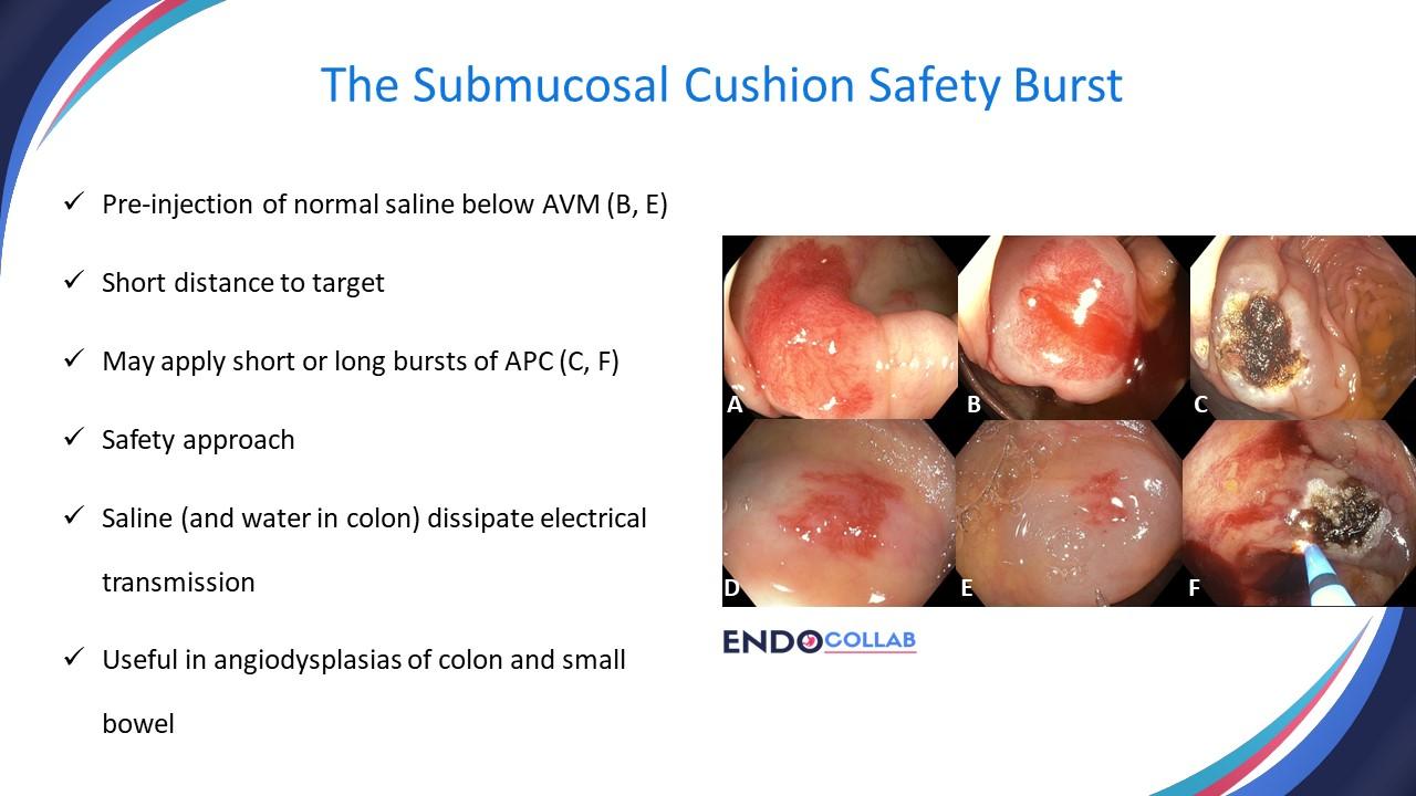Six Top Tips To Use Argon Plasma Coagulation When Treating Angiodysplasias: An Endoscopic Atlas